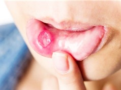 Mô hình học máy chẩn đoán ung thư niêm mạc miệng